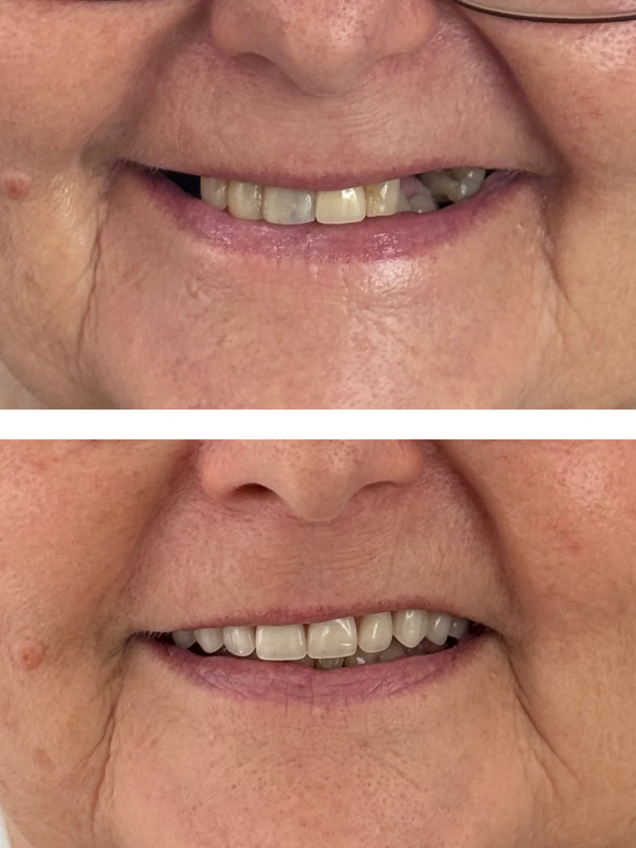 Antes e depois de reabilitação do sorriso na Clínica Sant'Ana