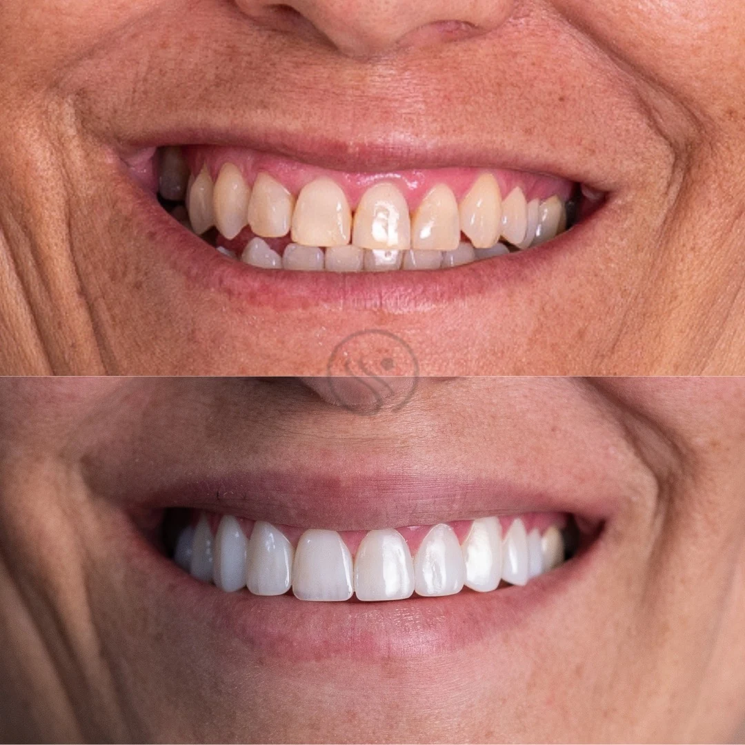 Resultado de facetas em resina na Clínica Sant'Ana