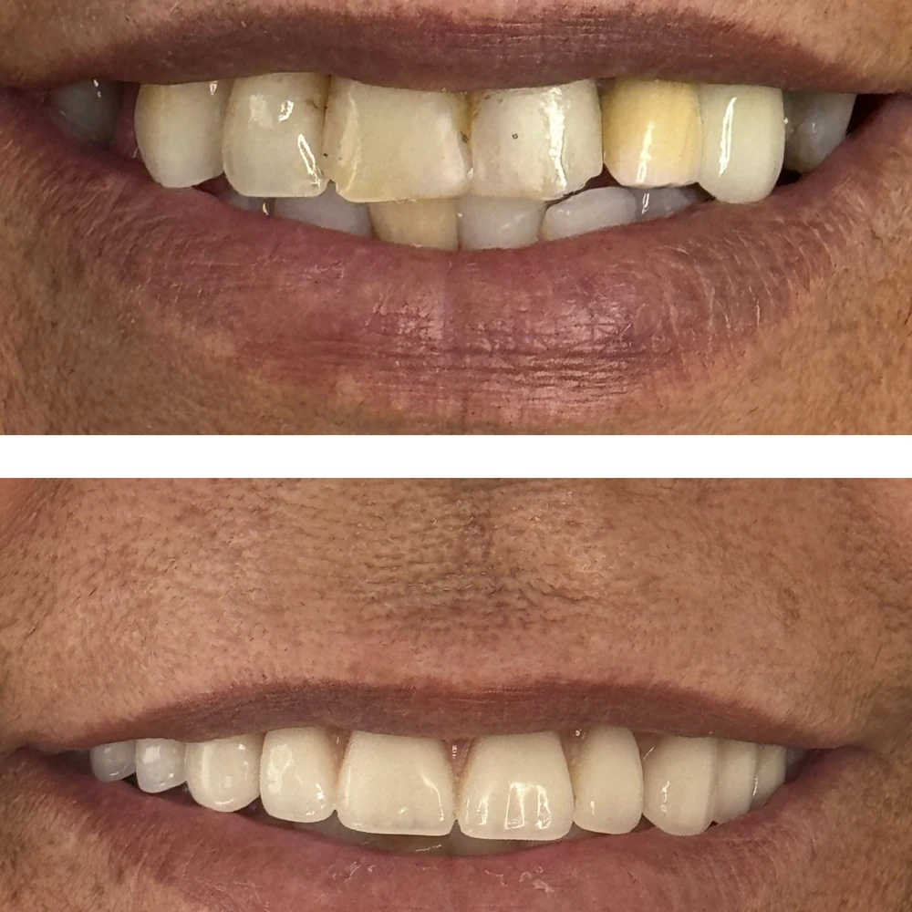 Antes e depois de reabilitação do sorriso na Clínica Sant'Ana